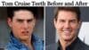 Image showing Tom Cruise's teeth transformation, highlighting the difference between his smile before and after treatment