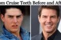 Image showing Tom Cruise's teeth transformation, highlighting the difference between his smile before and after treatment