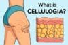 Image explaining cellululosis, a condition related to the skin, with a focus on its definition and effects.
