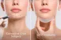 Corrective Chin Surgery vs chin implants comparison for facial balance and chin projection