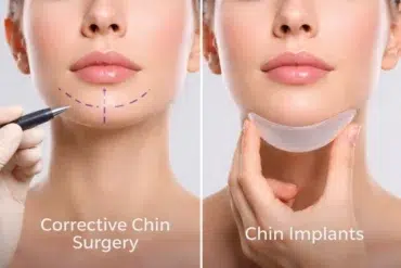 Corrective Chin Surgery vs chin implants comparison for facial balance and chin projection