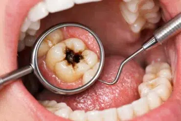 What Does a Cavity Look Like showing white spots, brown discoloration, and a visible hole on a molar