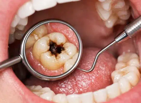 What Does a Cavity Look Like showing white spots, brown discoloration, and a visible hole on a molar