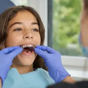 Palate Expander Before and After results showing teeth spacing and jaw expansion