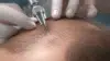Close-up of a person's scalp undergoing a hair transplant procedure with a surgical tool.
