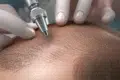 Close-up of a person's scalp undergoing a hair transplant procedure with a surgical tool.